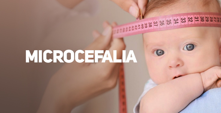 Imagem contendo o texto Microcefalia em letras maiúsculas e na cor branca, posicionado no centro do lado esquerdo. No lado direito, em primeiro plano, há um bebê de olhos claros com o punho perto da boca, enquanto mãos ao fundo medem o perímetro cefálico da sua cabeça usando uma fita métrica rosa.